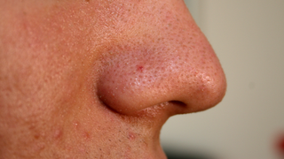 New Acne-Fighting Compound Blocks Inflammation and Kills Bacteria Without Irritating Side Effects